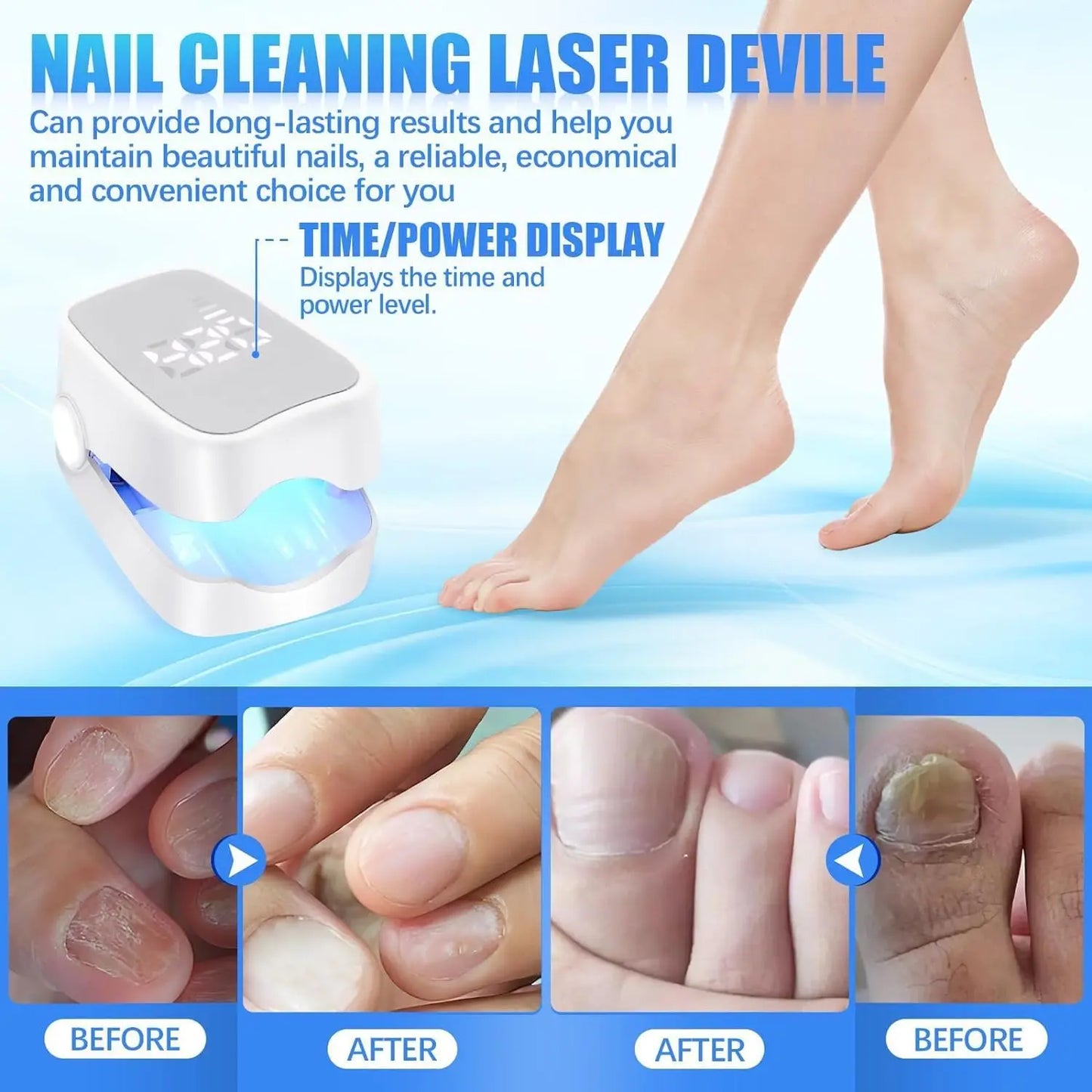 MycoBeam™ Laser Nail Therapy Device